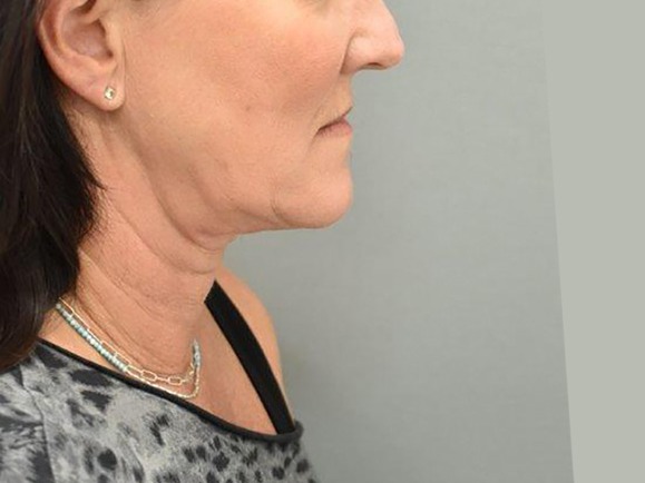 Case--2517 | Before Facelift and Neck Lift