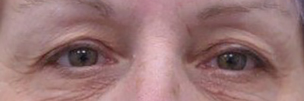 Case--8316 | Before Eyelid Surgery