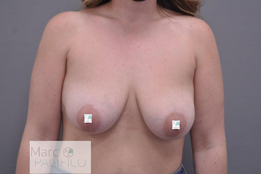 Case--8488 | Before Breast Augmentation w/ Mastopexy