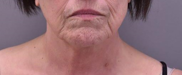 Case--6346 | Before Facelift and Neck Lift