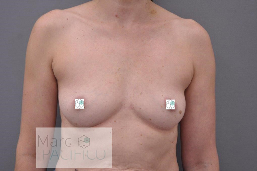 Case--5905 | Before Breast Augmentation