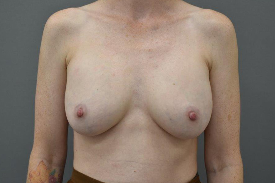 Case--2129 | Before Breast Implant Removal