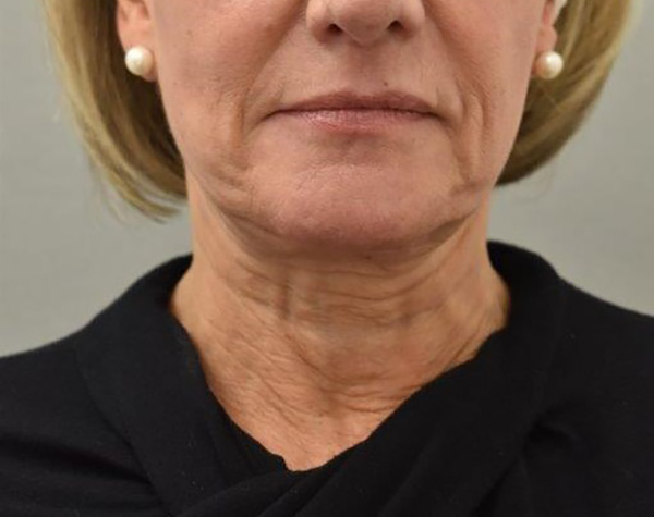 Case--9111 | Before Facelift and Neck Lift