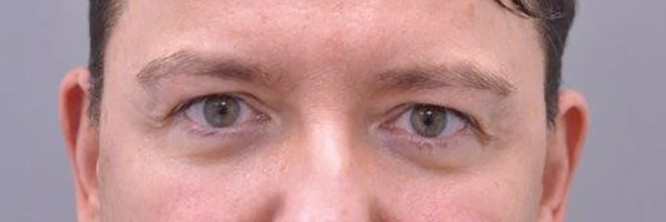 Case--9083 | Before Eyelid Surgery