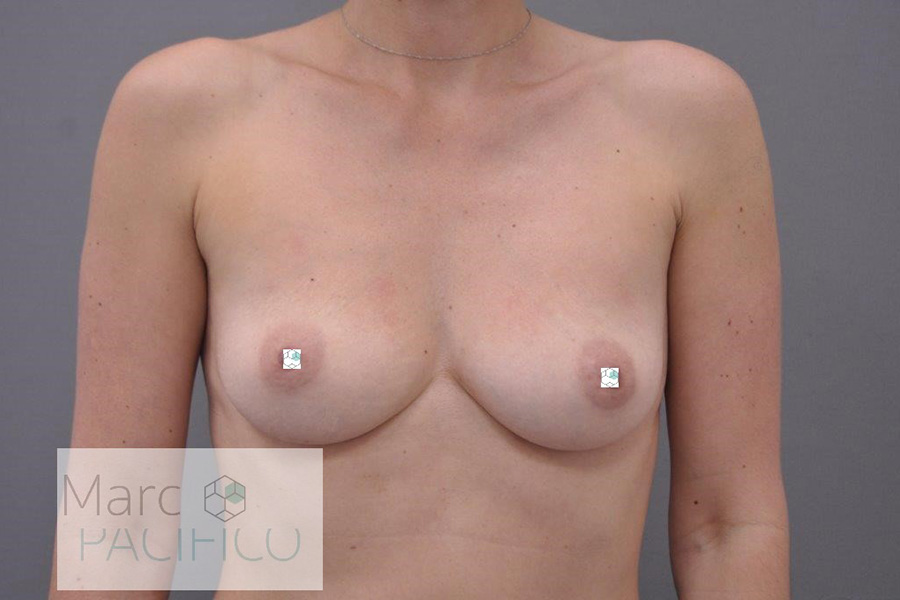 Case--6579 | Before Breast Augmentation