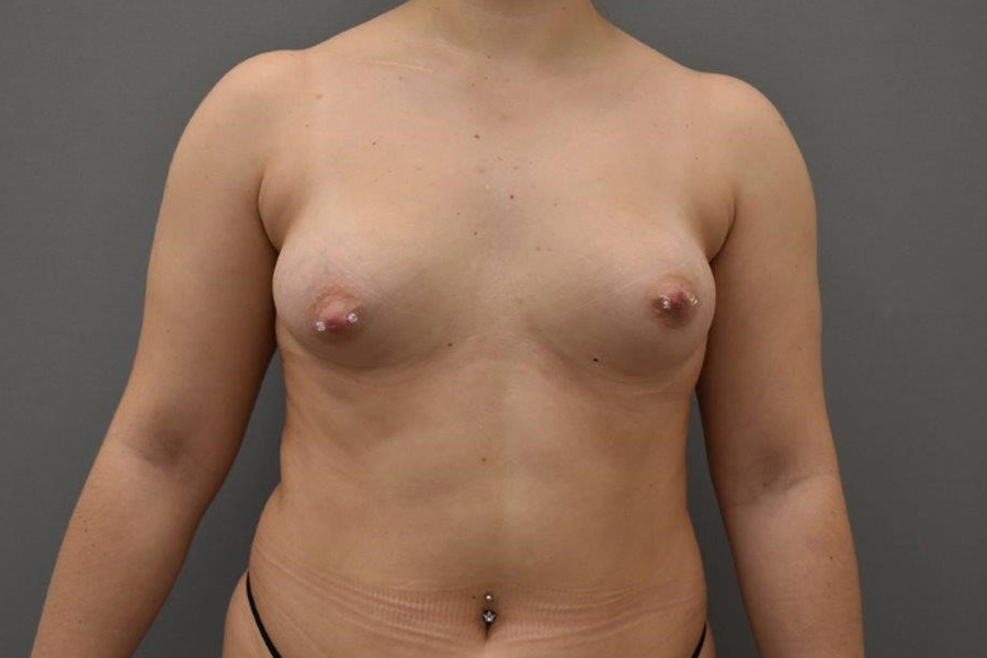 Case--6076 | Before Breast Asymmetry