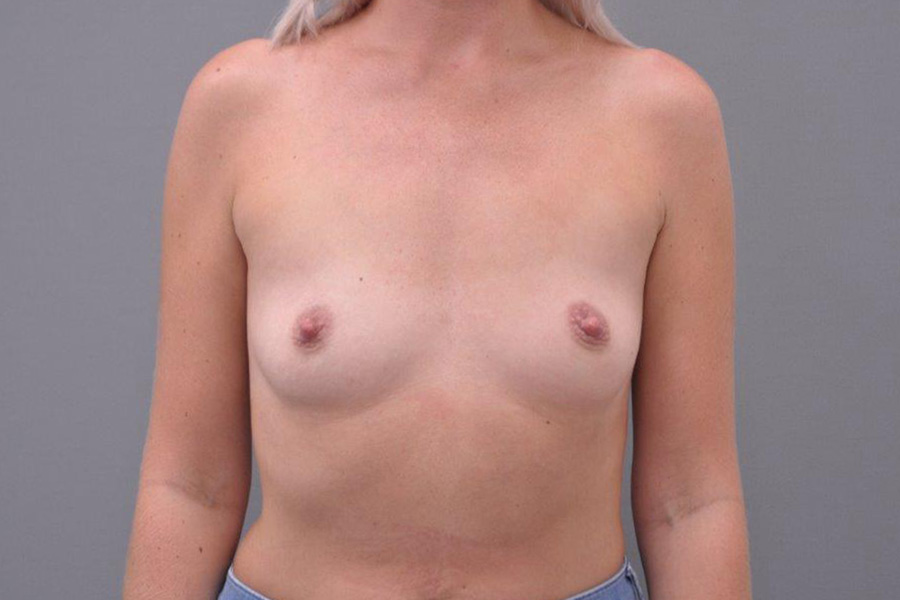 Case--2514 | Before Breast Augmentation