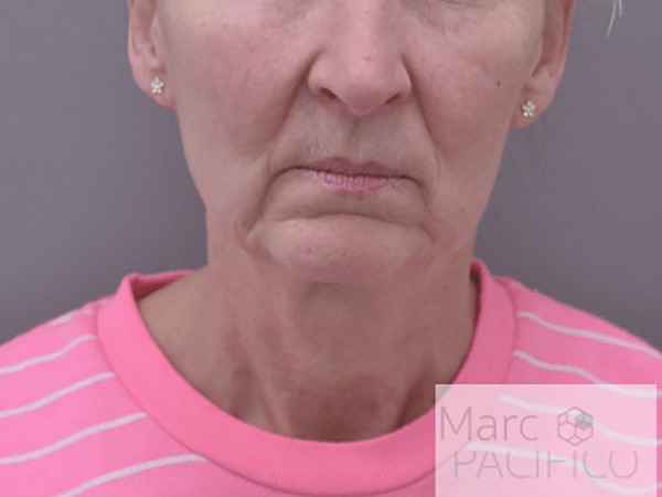 Case--4518 | Before Facelift and Neck Lift