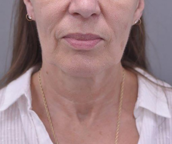 Case--4567 | Before Facelift and Neck Lift