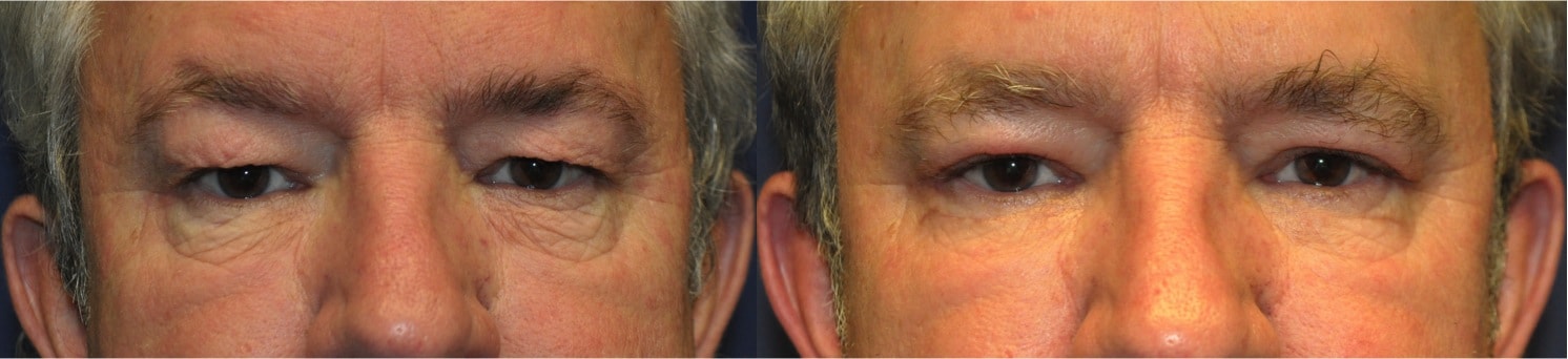 lower eyelid blepharoplasty kent